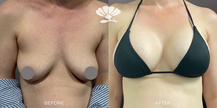 Breast Asymmetry Surgery in Perth