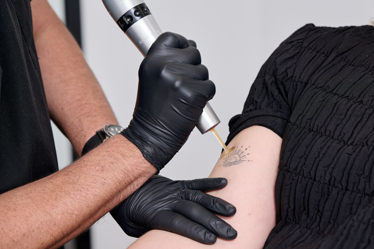 Laser Tattoo Removal South Walton - Tattoo Removal 30A