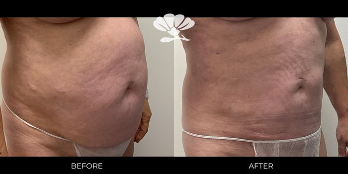 Liposuction Perth Waist Stomach 72